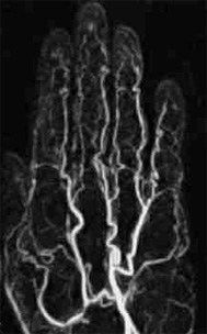 MR angiography